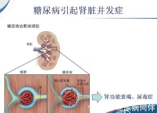 糖尿病患者|糖尿病肾病】糖尿病离尿毒症有多远？该怎样预防？