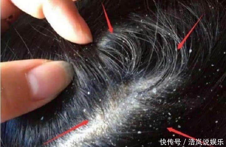 颗粒|头皮上抠下“白色颗粒物”一般逃不过这“3点原因”，别忽视