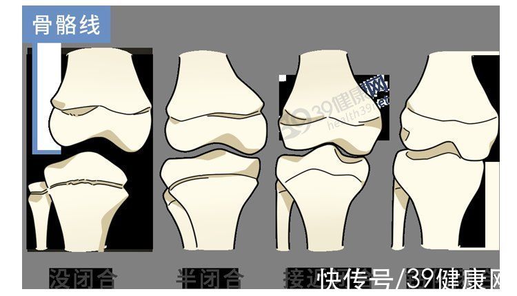 李亚诺|花了家里16万切断双腿骨头，只为增高7.2厘米，如今与后遗症为伴