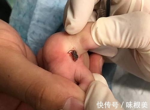 寄生处|“小血痂”竟然是孩子的夺命虫!医生:幸亏发现的及时