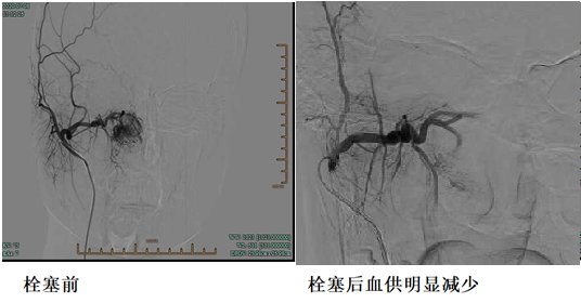  出血|少年反复流鼻血却未深究原因，没想到竟是肿瘤找上门！鼻子出现这些问题赶紧去医院