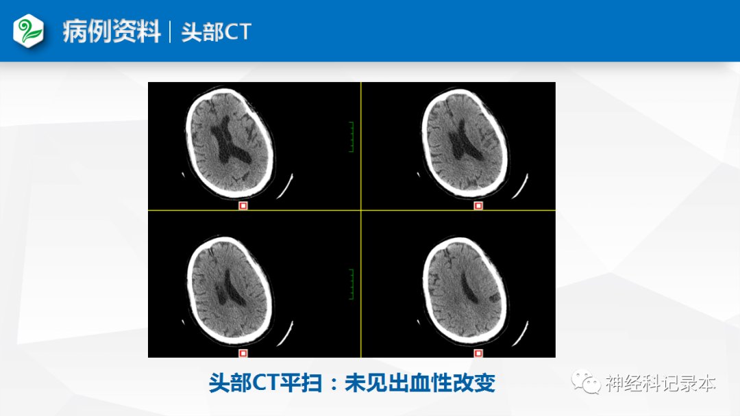 溶栓|特殊情况下静脉溶栓决策两例