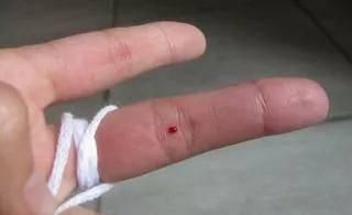 四缝穴,扎一次见效,二次痊愈,真是绝了