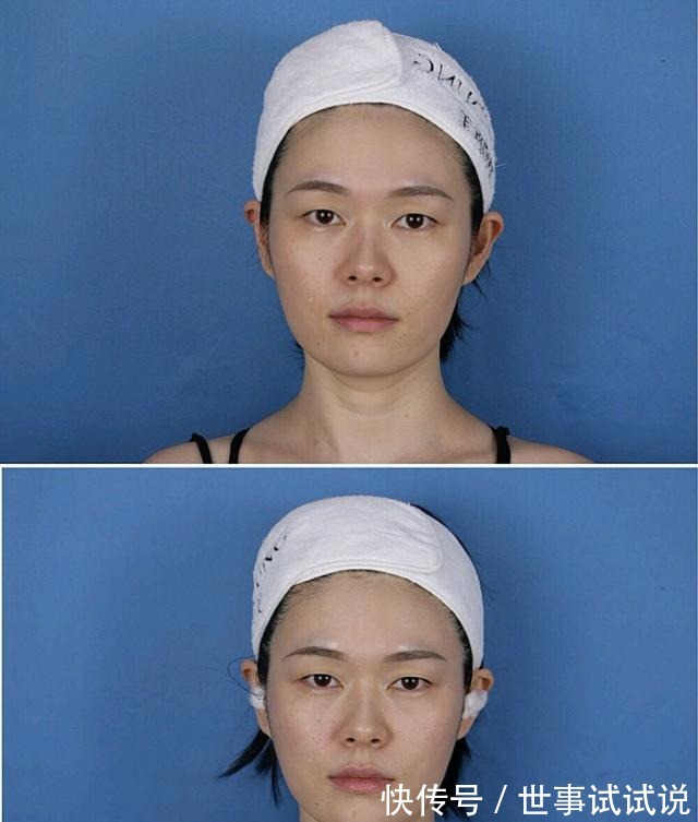 效果 为什么我做了热玛吉没效果!