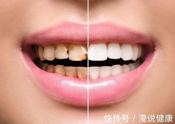 刷牙|这个健康项目,97%的中国人为何不合格?做好3件事,省钱又省心