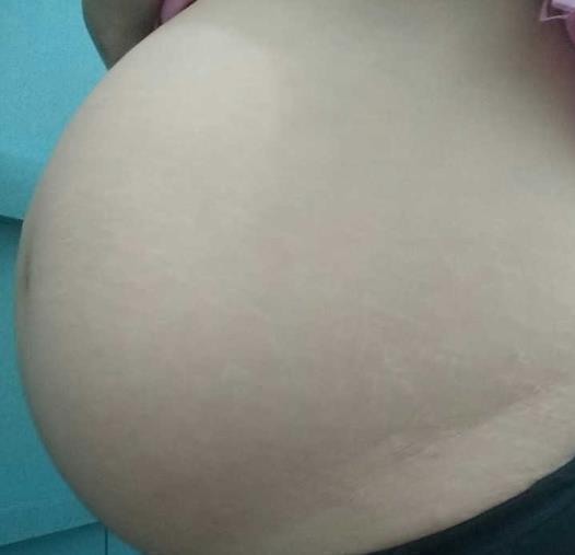 先兆流产|出现褐色分泌物,这可能是先兆流产信号,别疏忽