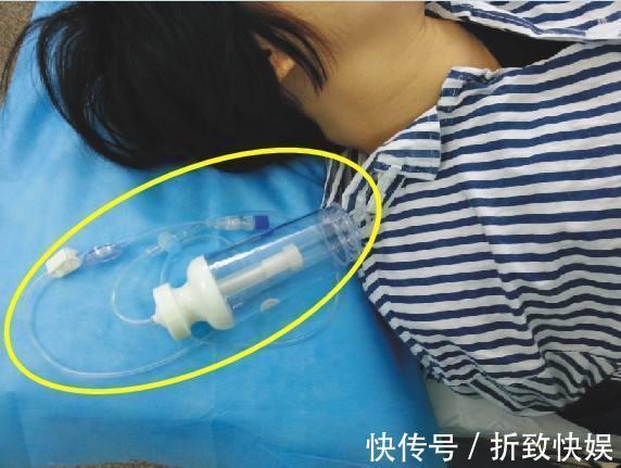 镇痛泵|剖腹产后该不该使用镇痛泵医生讲出其中利害,全由家属来做决定