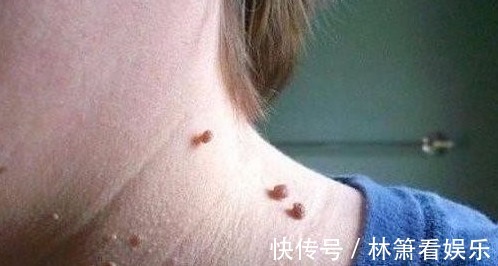 瘊子|农村有种常见的野草,是治疗瘊子的良药,分分钟治好,不再长