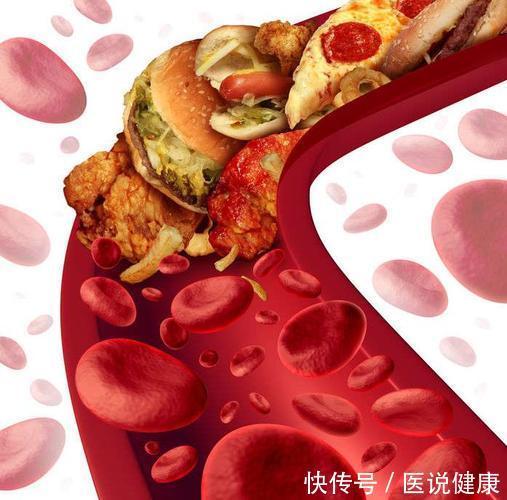 谣言|吃素可以降血脂?谣言!医生表示:关于高血脂的4个误区,需了解