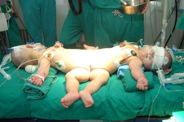 医生|两年备孕怀上双胞胎,B超结果是连体婴儿,坚持下来后意外惊喜!