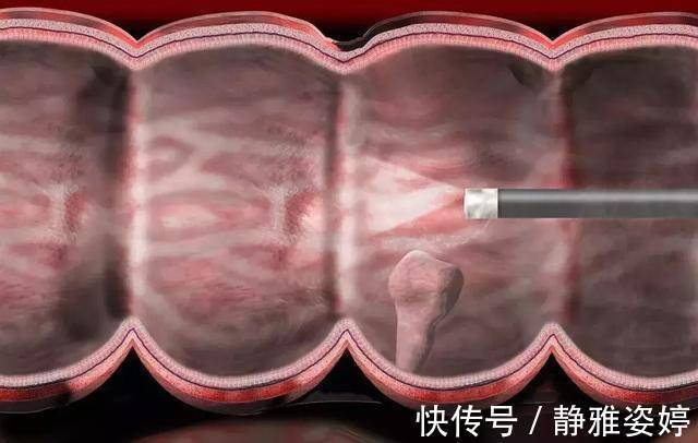 大肠癌|大肠癌一发现就是晚期，肿瘤科医生忠告，四个症状别再一拖再拖