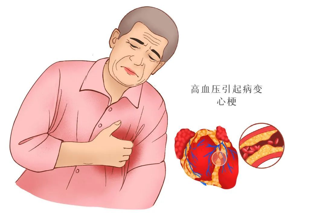 高血压患者|全国高血压日：血压多少算正常？您的血压您做主！