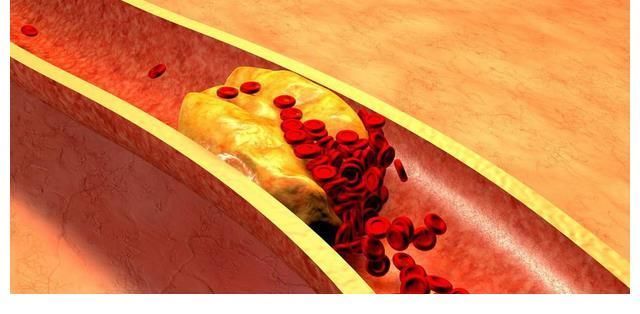 甘油三酯|高血脂不能碰牛奶吗?医生直言:不想甘油三酯升高,2物趁早远离