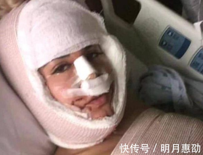 整容手术|女子花重金整容,一年经历13次整容手术,整容前后判若两人