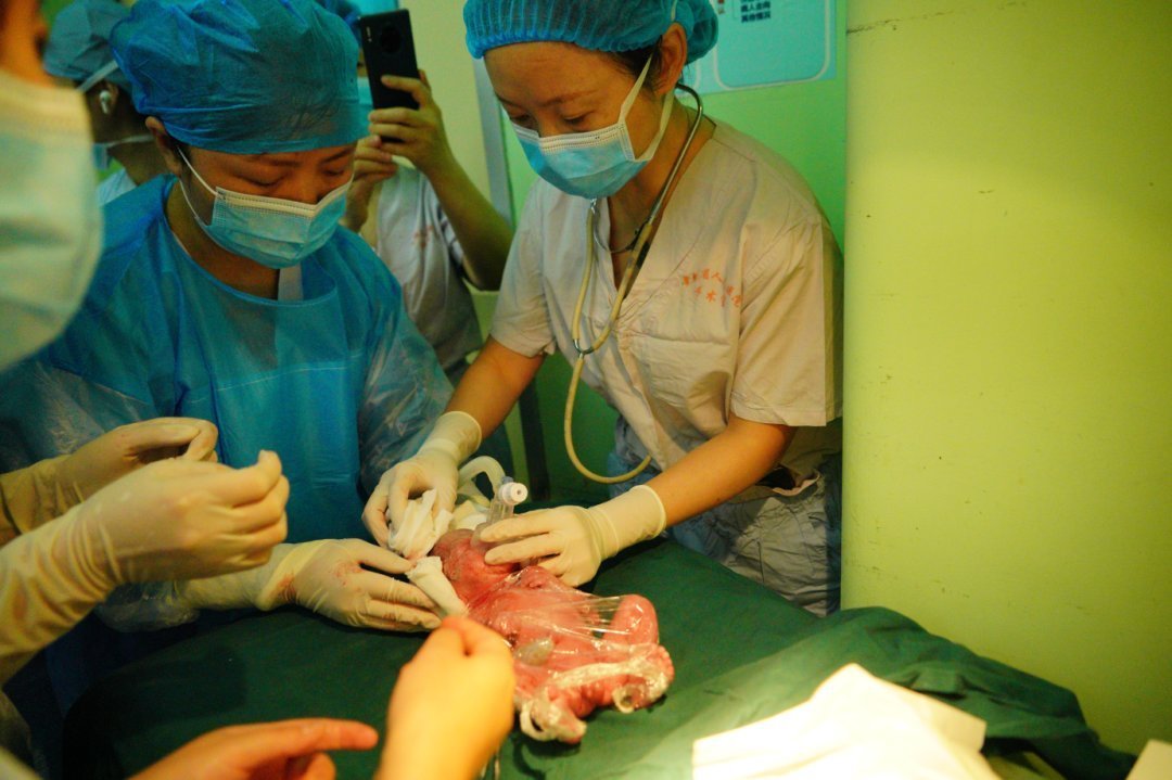 胎儿|世界罕见!胎儿在腹腔内生长了28周后出生了