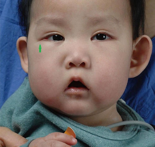 睫毛|宝宝长得太漂亮也是一种病?“歌舞伎综合征”到底是个什么鬼