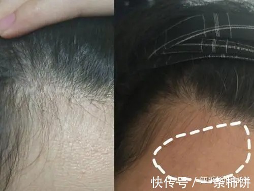 角质层|告别!九个闭口形成的原因!好皮肤才是仙女的本钱来一起变美吧