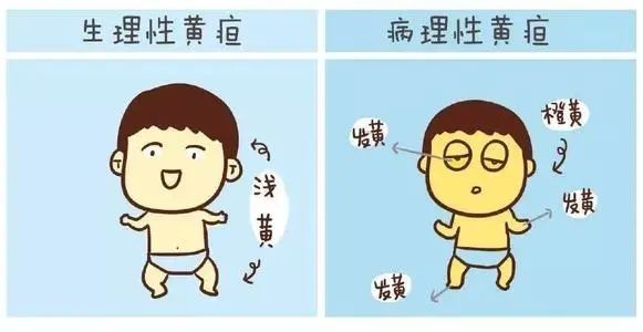 生理性黄疸？病理性黄疸？教你怎么判断