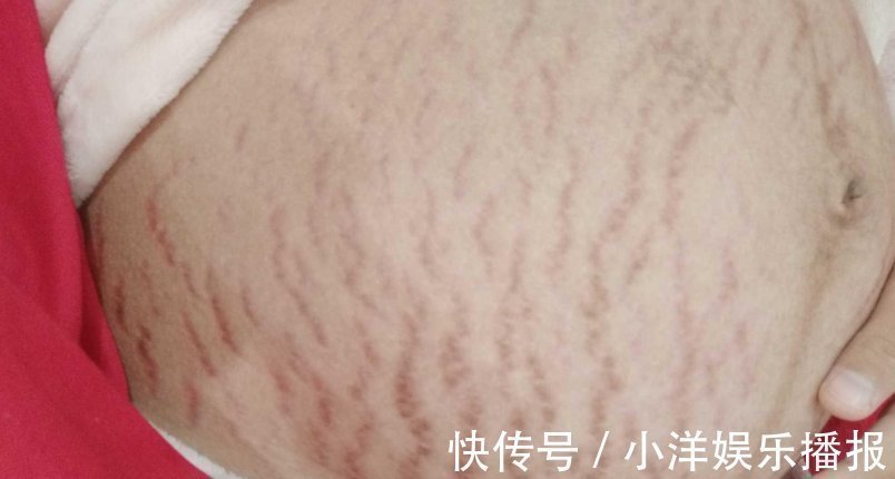 妊娠纹|怀孕7个月的孕妈每天抹油,但还是长了妊娠纹,医生的一句话扎心了
