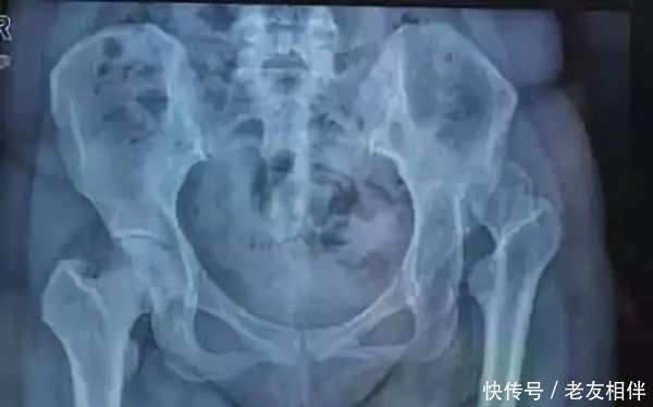 要命|髋关节疼起来真要命,到底为什么这么痛?要怎么治疗?