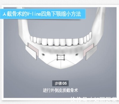 操作方法 下巴截骨术危险吗?手术注意事项须知及术后怎么护理?看完全明白了!