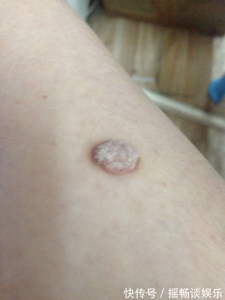 小鹏|女婿将HPV传染给丈母娘，竟因为共用这样东西，医生：太胡闹