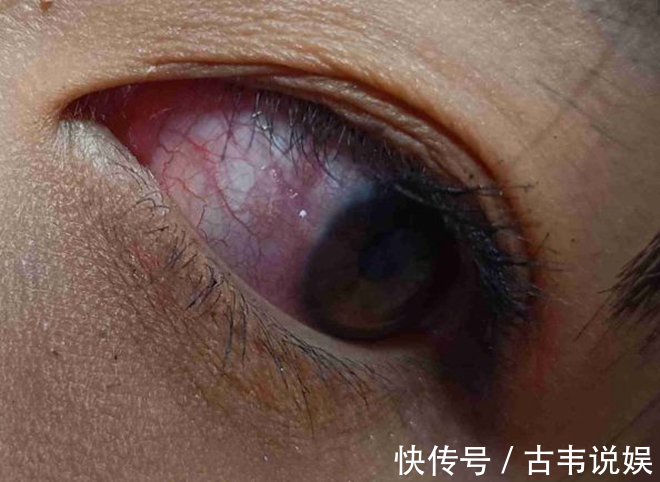 肝炎|“肝不肝净”,眼睛会“说话”,有这4种“迹象”,肝炎或已来袭