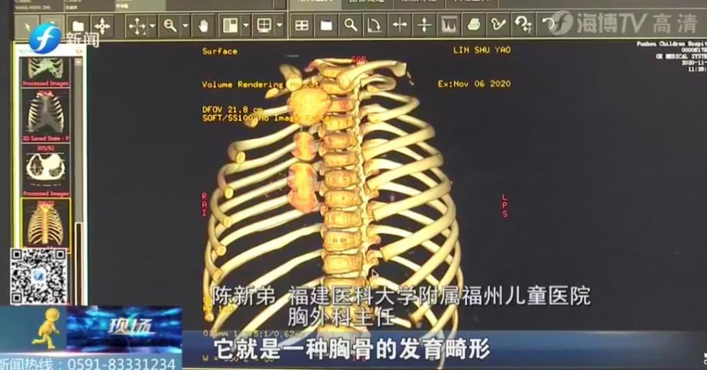  女童|5岁女童＂漏斗胸＂凹陷紧邻心脏，离脊椎不足5厘米！