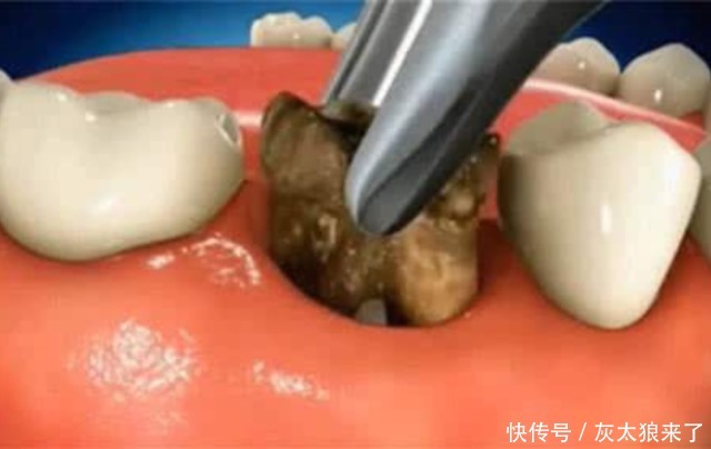 蛀牙真是被“蛀虫”咬的吗?3D动画演示全程,看着都感觉疼!