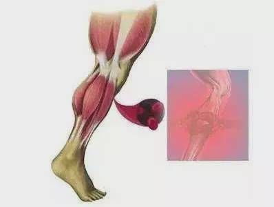 横纹肌溶解症|拒绝夏季疯狂锻炼,运动需适度,不要盲目健身!