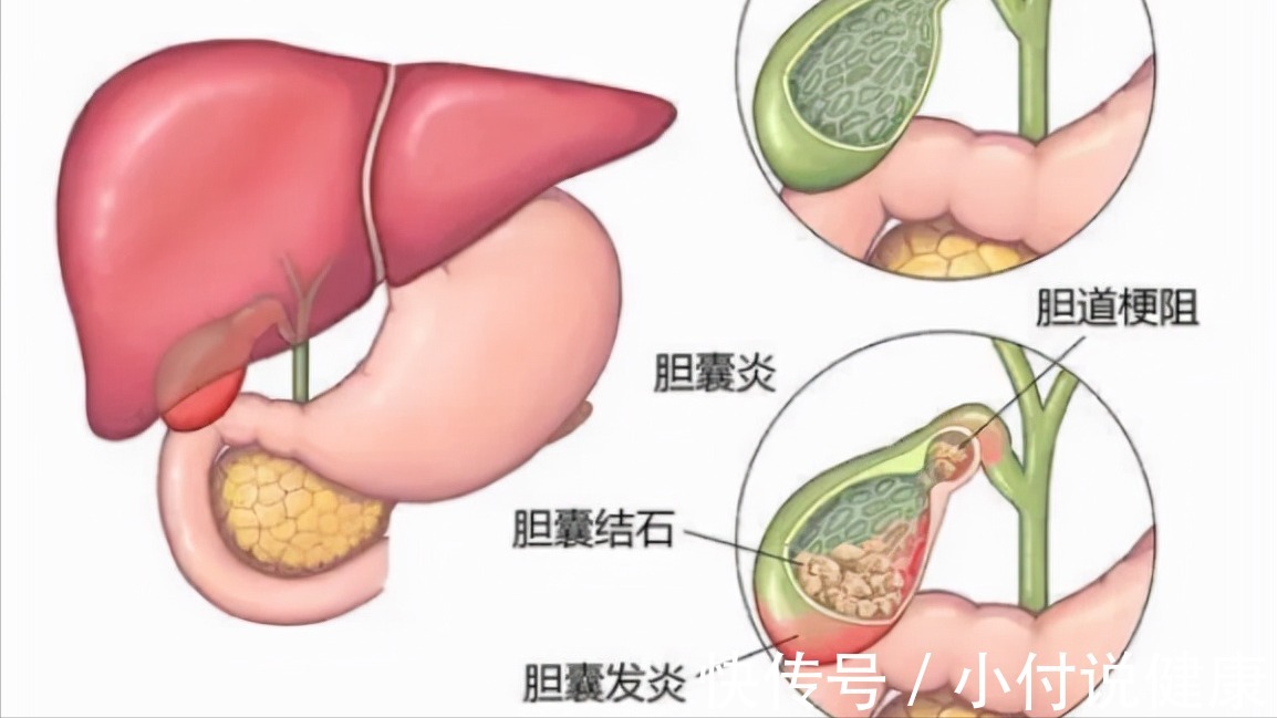 结石|别再把消化不良当胃病!或许是胆囊不好了,听听医生怎么说