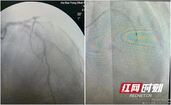 旋磨术|湘西州人民医院：自主开展冠脉内旋磨术 实现湘西“零”突破