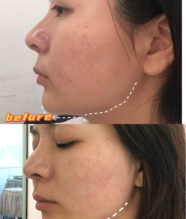 效果 医美抗衰初体验!效果真的很神奇!医美抗衰初体验!效果真的很神奇!