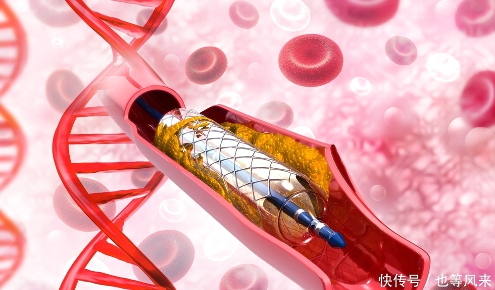 医生|俩冠心病患者,一个做了支架手术后仍丧命,一个拒绝支架仍健在