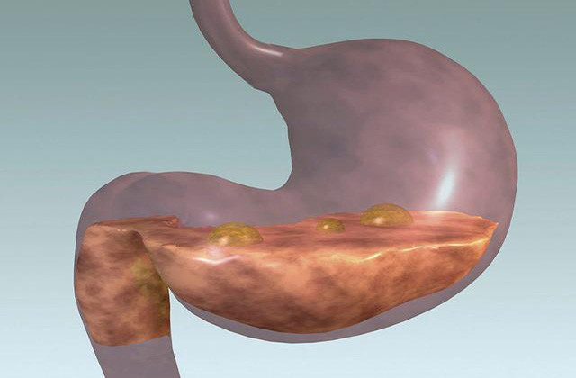 幽门螺杆菌“救星”，泡水喝一喝，养胃除菌，胃病自破