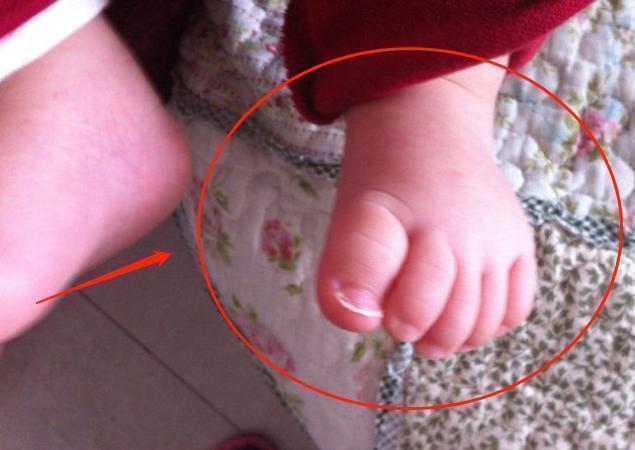 洞洞|5岁孩子双脚变形,只因长时间穿这种鞋子,父母要注意