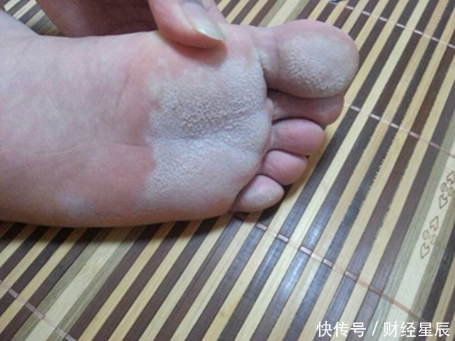 干燥|双脚是肝脏健康的“晴雨表”,连续出现这3种异常,肝病来袭