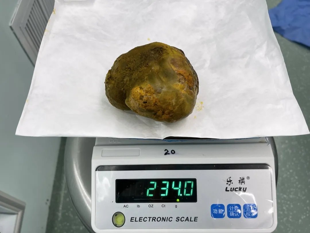 蛔虫|重234克直径12厘米！世界上最大的单颗胆总管结石成功摘除