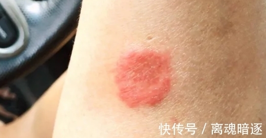 宠物|孩子头上长猫藓怎么办?