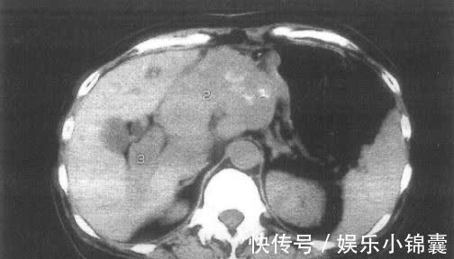 李姐|每天一个鸡蛋,母女双双查出胃癌,1种“鸡蛋”怎能当饭吃?