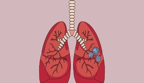 磨玻璃肺结节随访观察,会有癌变的可能吗?