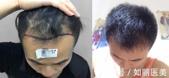 毛囊 植发的费用是多少?1W够不够呢?