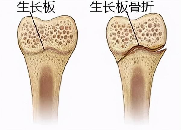 长高|打篮球长高，练体操变矮？别再被骗了，你的身高早已被基因定好了