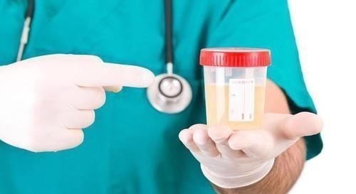 糖尿病|糖尿病人泡沫尿时有时无,是什么原因?本文为你说清