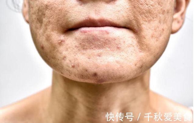 粘稠度|血脂高不高,看头就知道,若没有4种症状,恭喜,血管还算通畅