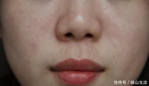 雄性激素|唇毛过于浓密，说明了啥？唇毛会越刮越多吗？很多女性还不自知