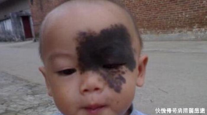 毒素|宝宝出生后身上出现大片红疹和胎记,都是孕妇不忌口吃了这些东西