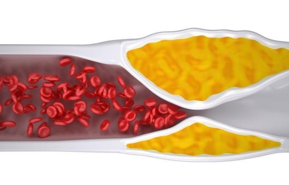 颈动脉狭窄|颈动脉出现硬化斑块，必须吃他汀和阿司匹林？本文辟谣讲出实情