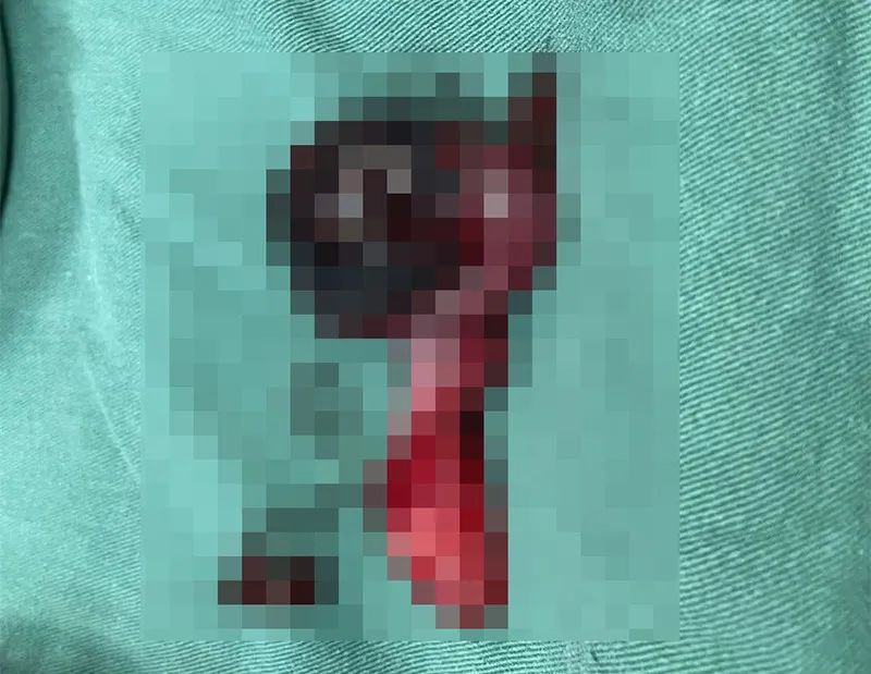 提睾肌|男孩睡觉时突然「蛋疼」,到医院一看,已经不得不切除