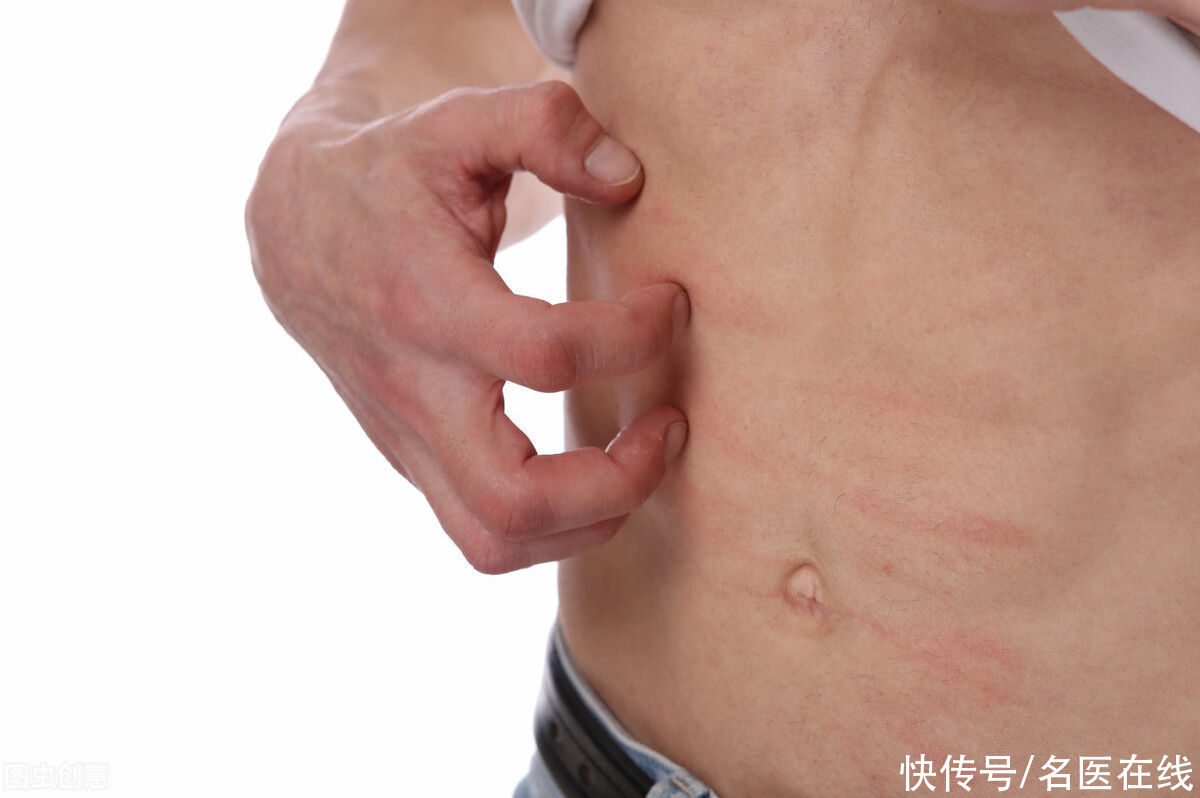 阴囊|乳房、肛门、阴囊统统躲不过！被湿疹入侵的隐私要怎么治？